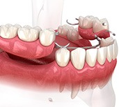 Digital image of a partial denture