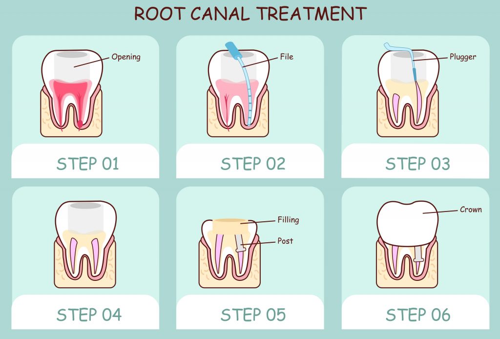 How to Know You Need a Root Canal in Rockledge Premier Walkin Dental