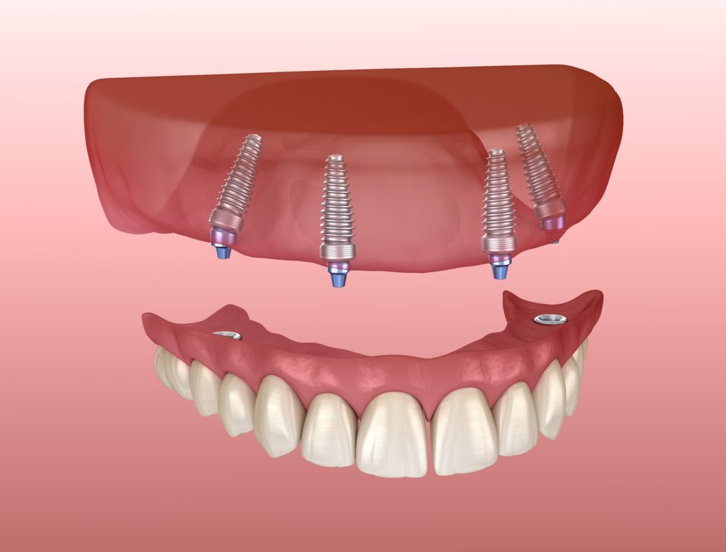 5-tips-for-transitioning-to-implant-dentures-in-rockledge