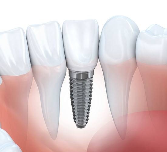 dental implant with crown replacing missing tooth